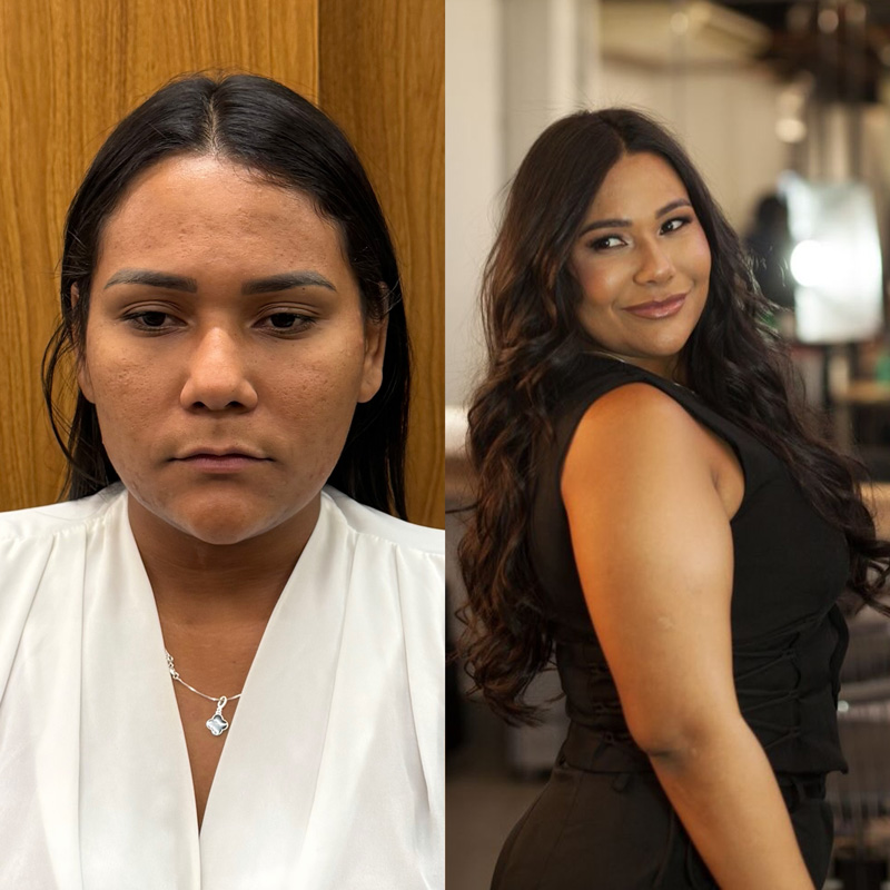 Chaiany mostrou antes e depois de tratamentos estéticos - Foto: Reprodução/ Instagram@chaianydeandrade