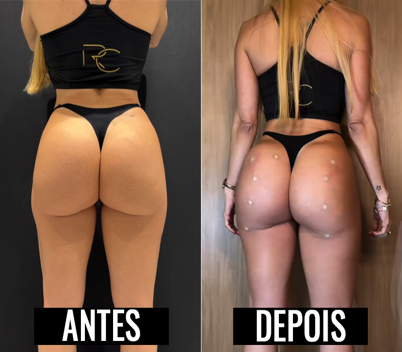 Denise Dias mostrou antes e depois de procedimento para recuperar bumbum - Foto: Divulgação