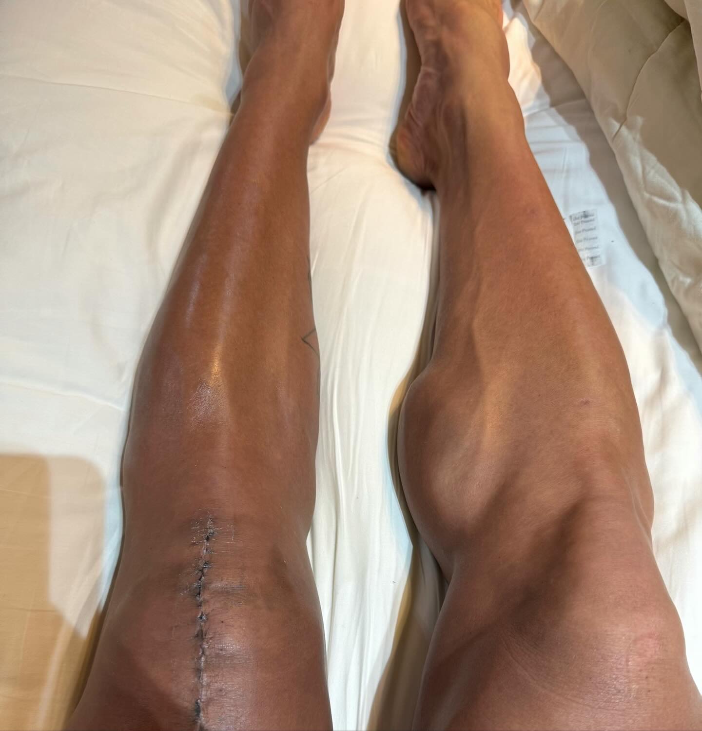 Gracyanne Barbosa desabafou ao mostrar corpo um mês após cirurgia - Foto: Reprodução/ Instagram@graoficial