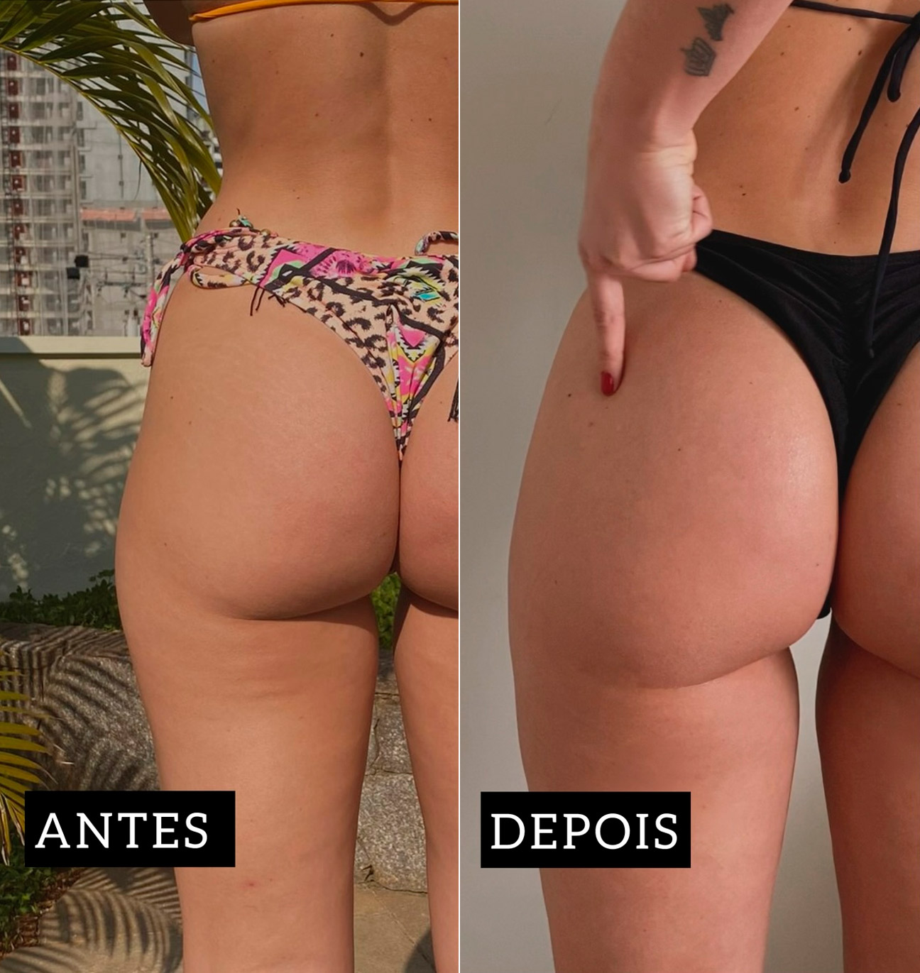 Jéssica Mueller mostrou antes e depois da lipo no culote - Foto: Reprodução/ @eujessicamueller