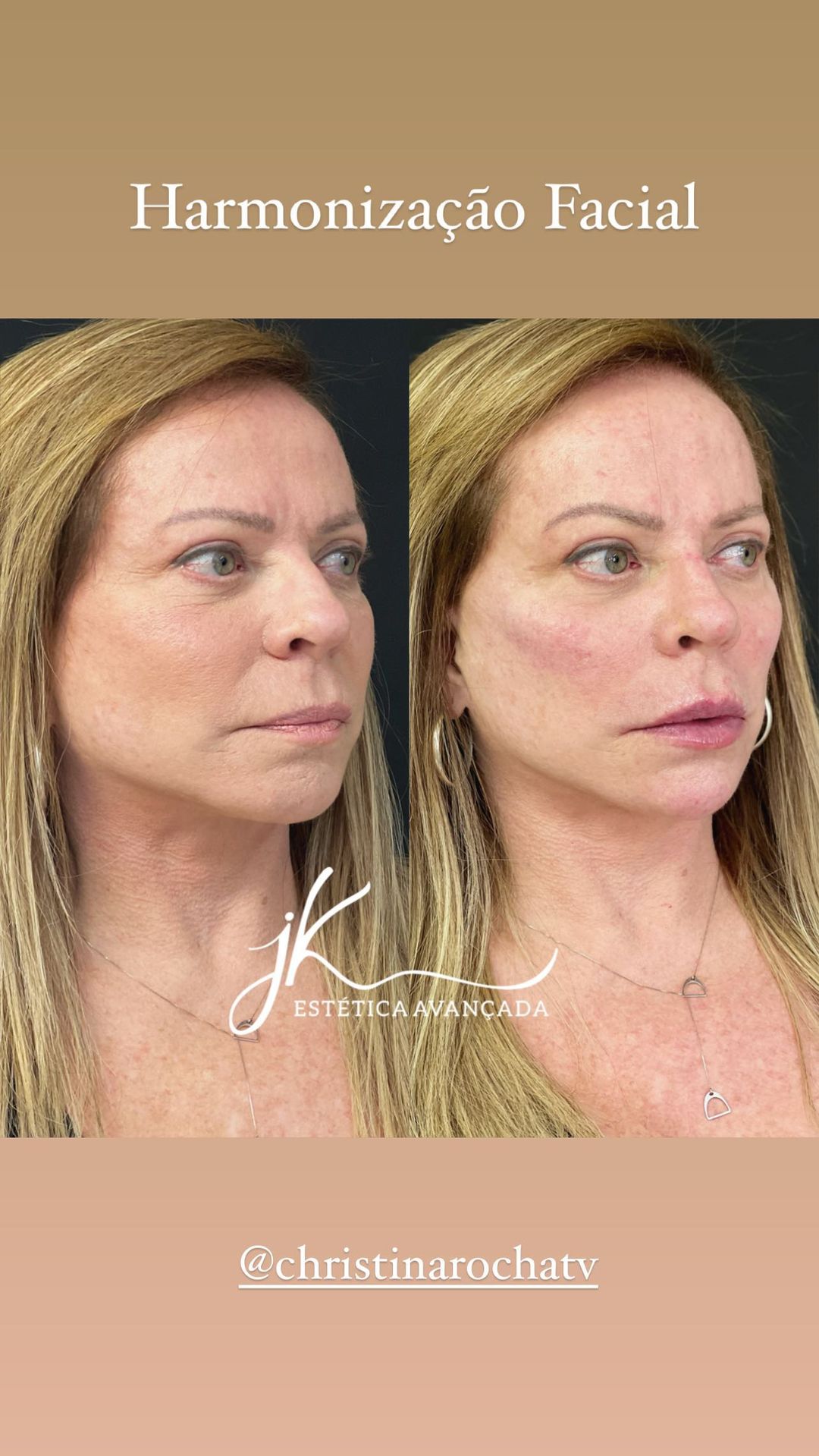 Christina Rocha se submeteu a harmonização facial aos 65 anos - Foto: Reprodução/ Instagram@jkesteticaavancada