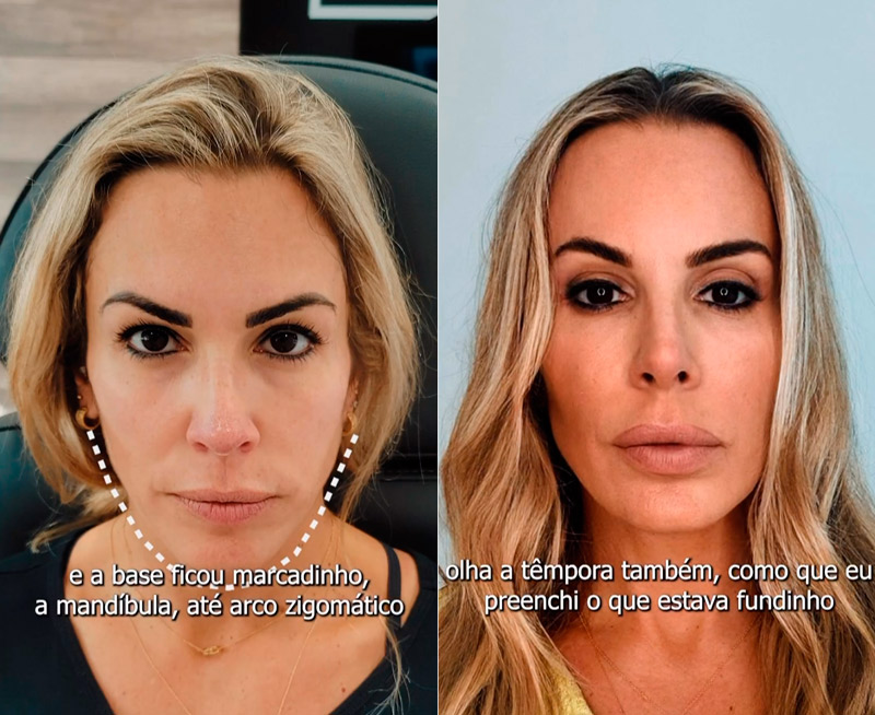Joana Prado mostrou antes e depois de harmonização facial - Foto: Reprodução/ Instagram@forever.essential