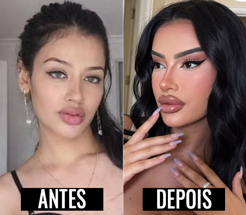 Júlia Medeiros antes e depois dos procedimentos no rosto - Foto: Divulgação/ CO Assessoria