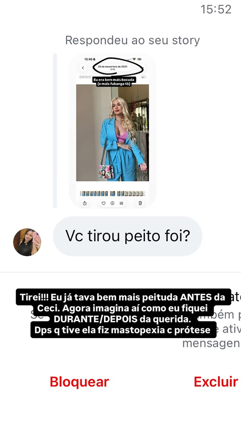 Karoline Lima postou foto antiga (à direita) e falou sobre retirada de procedimentos - Foto: Reprodução/ Instagram@karolinel