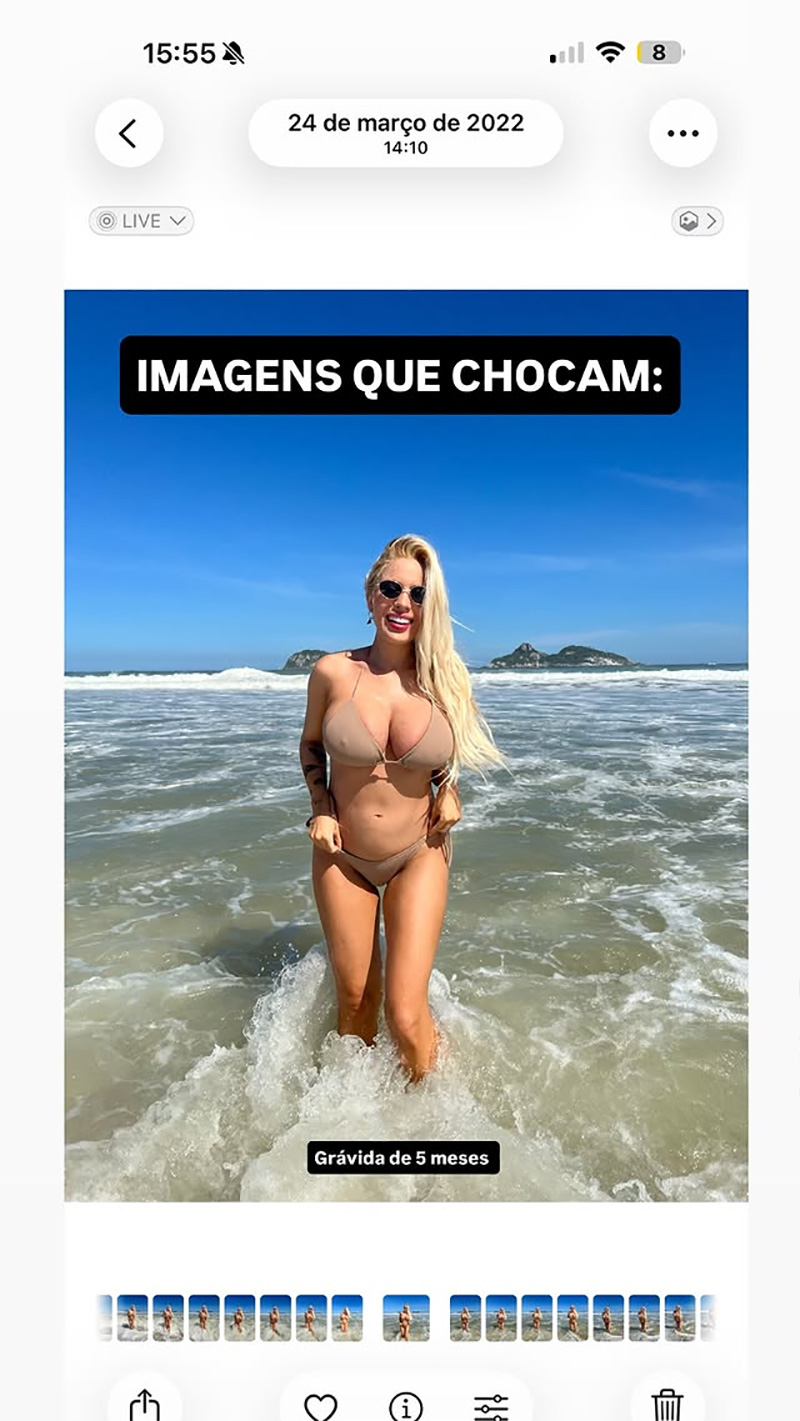 Karoline Lima postou foto antiga (à direita) e falou sobre retirada de procedimentos - Foto: Reprodução/ Instagram@karolinel