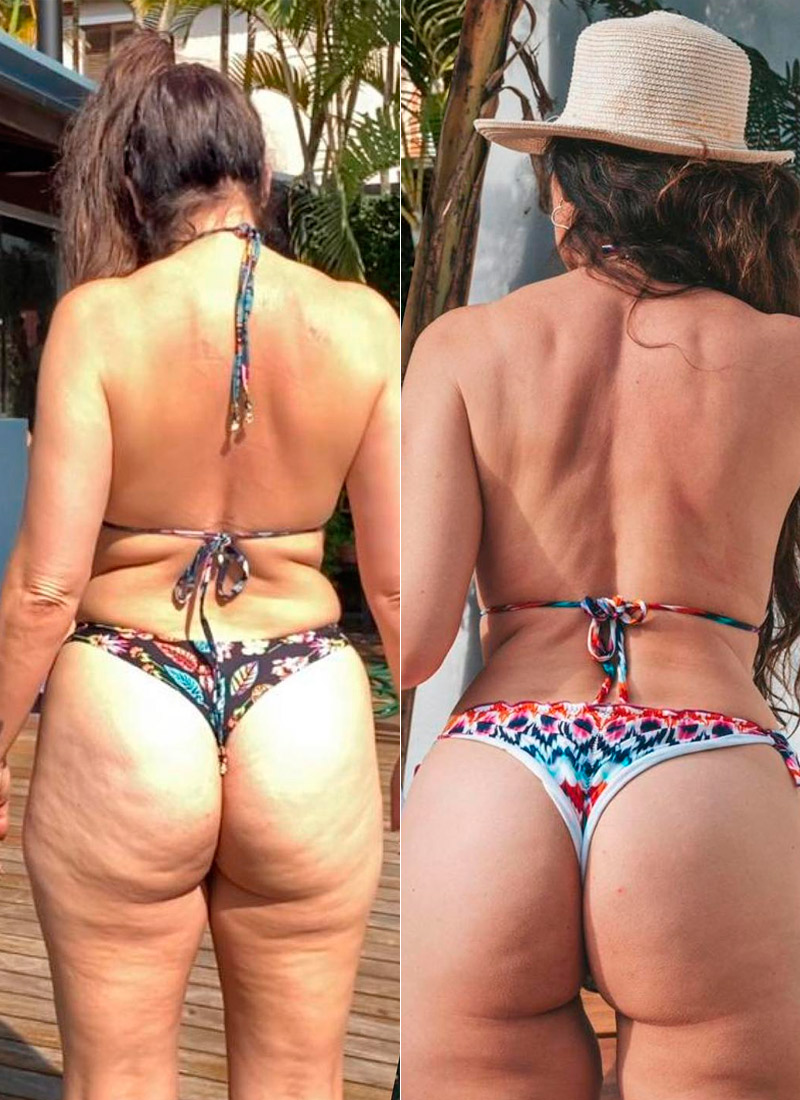 Luiza Ambiel mostra antes e depois do bumbum - Foto: Reprodução/ Instagram@luizaambieloficial