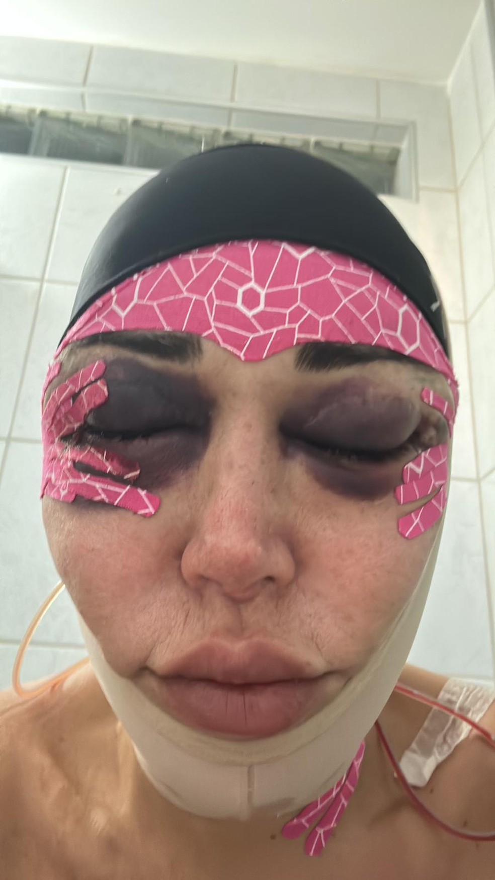 Marcela Porto exibiu hematomas e inchaço após procedimentos estéticos no rosto - Foto: Arquivo pessoal