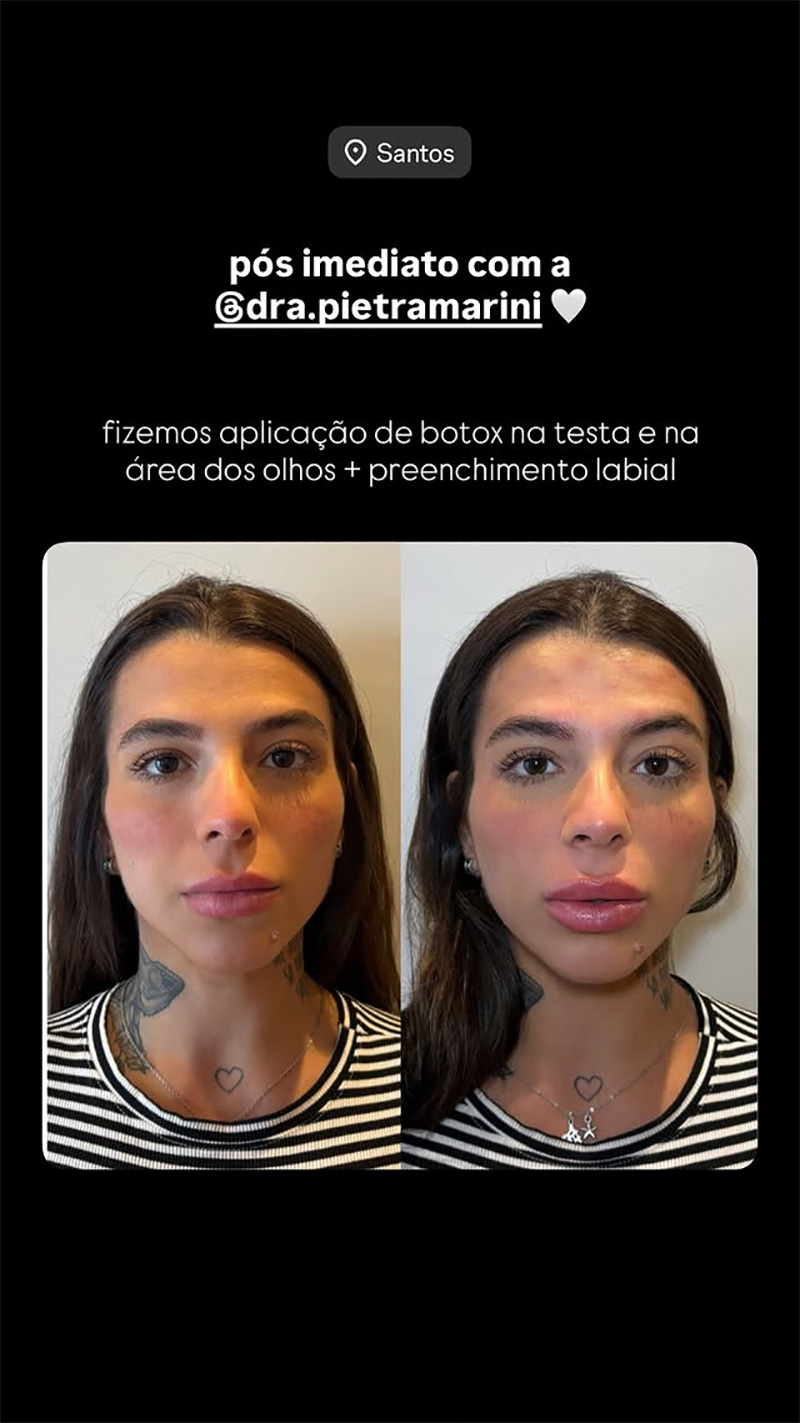 Petra Mattar mostrou resultado de procedimentos no rosto - Foto: Reprodução/ Instagram@petra