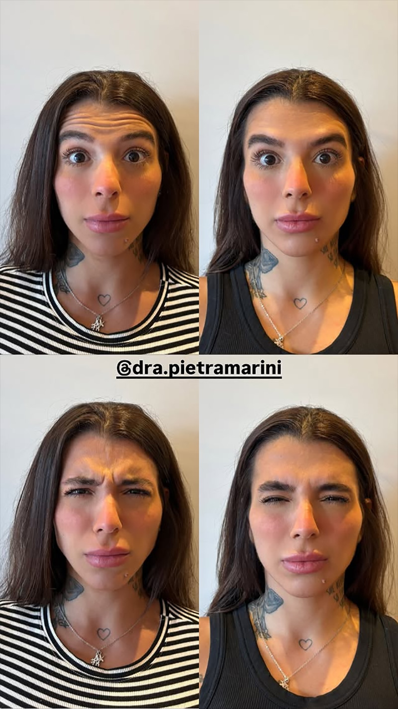 Petra Mattar mostrou resultado de procedimentos no rosto - Foto: Reprodução/ Instagram@petra