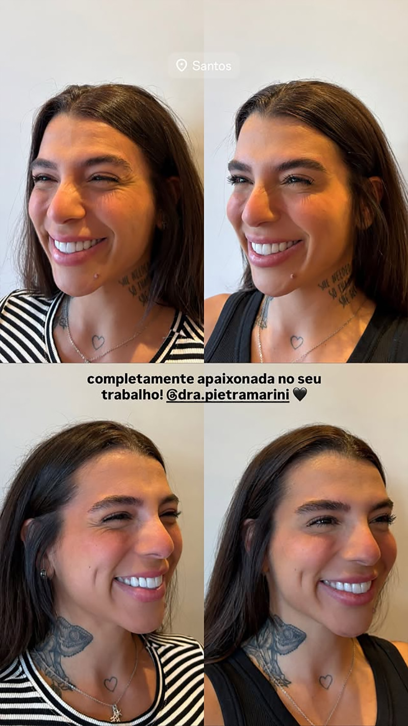 Petra Mattar mostrou resultado de procedimentos no rosto - Foto: Reprodução/ Instagram@petra