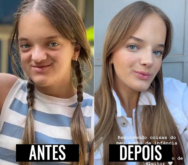 Rafaella Justus antes e após duas rinoplastias - Foto: Reprodução/ Instagram@rafapinheirojustus