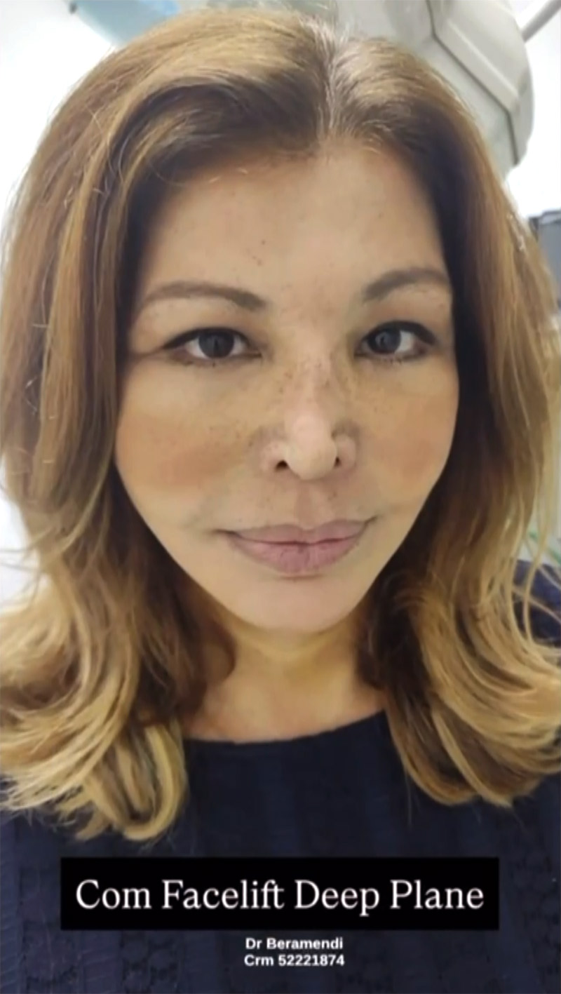 Roberta Close fez harmonização facial em clínica do Rio de Janeiro - Foto: Reprodução/ Instagram@clinicadrberamendi