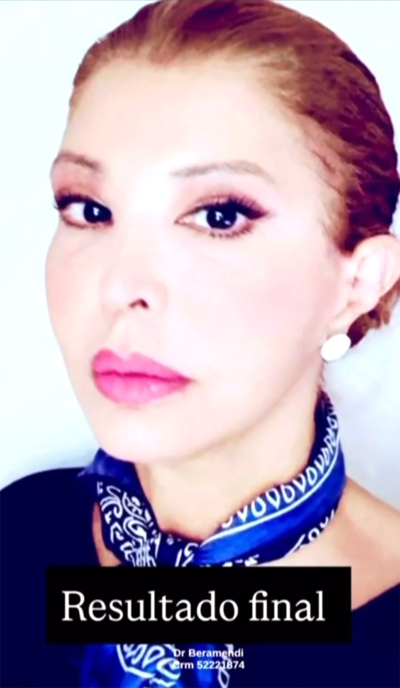 Roberta Close fez harmonização facial em clínica do Rio de Janeiro - Foto: Reprodução/ Instagram@clinicadrberamendi