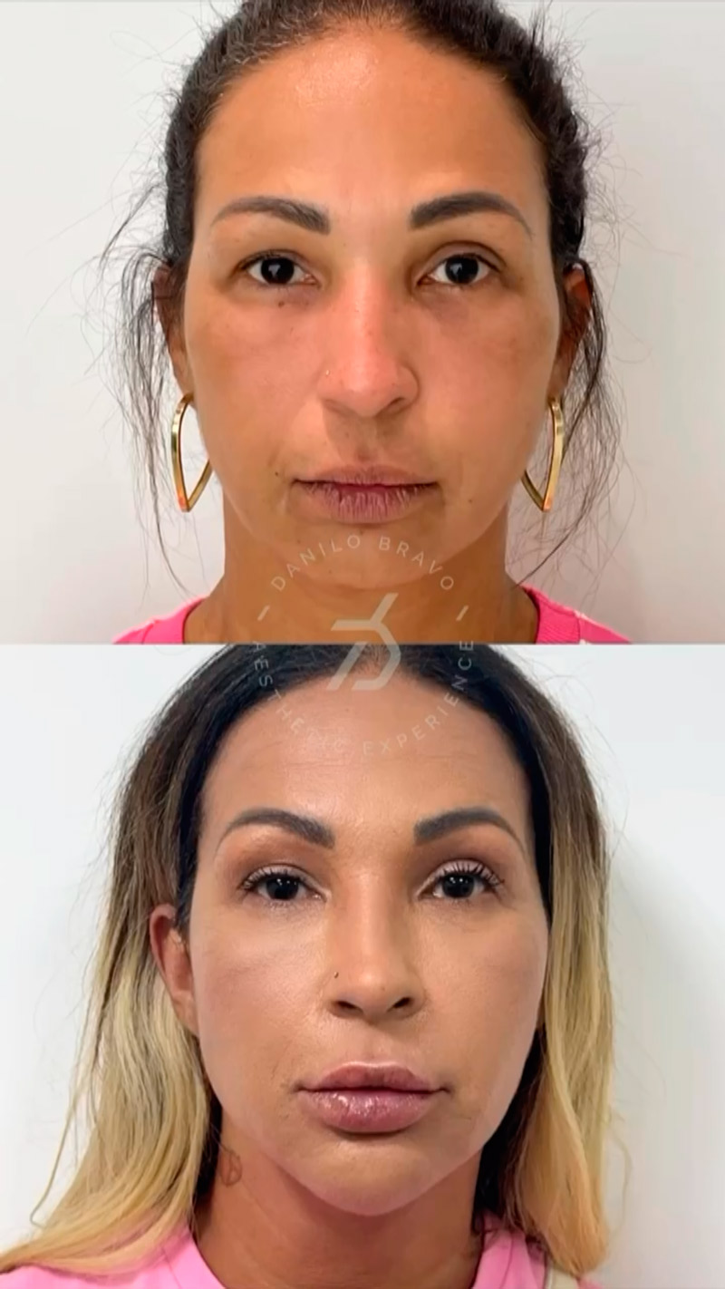 Valesca Popozuda mostrou mudança no rosto nos últimos três anos - Foto: Reprodução/ Instagram@valescapopozuda