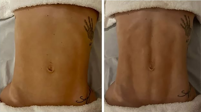 Virginia Fonseca mostrou antes e depois de drenagem linfática - Foto: Reprodução/ Instagram@virginia