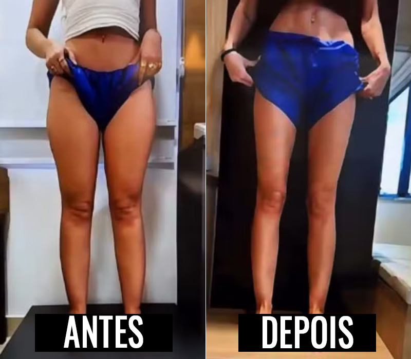 Yasmin Brunet antes e após o tratamento de lipedema - Foto: Reprodução/ Instagram@yasminbrunet